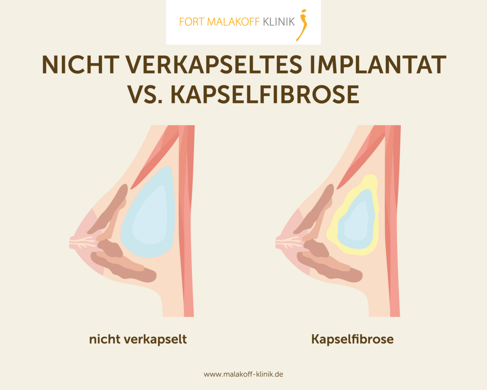 6 Monate nach der OP: So minimieren Sie Kapselfibrose-Risiken – Langzeit-Tipps Med Center Türkiye