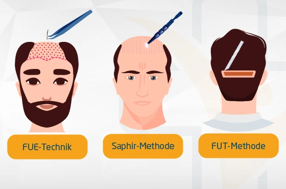 Alternative zur DHI-Methode