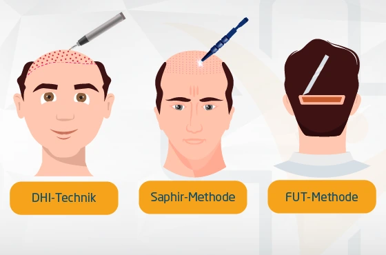 Alternative zur FUE-Methode