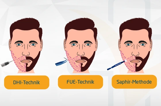 Arten der Barttransplantation Turkei