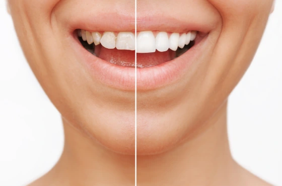 Beste Zahnklinik Turkei Zahn-Veneers