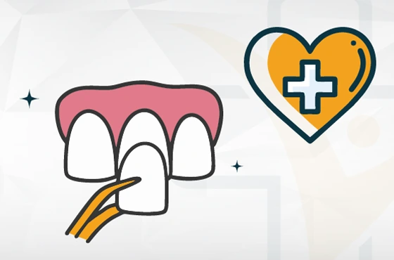 Dental-Veneers Eine ästhetische Lösung