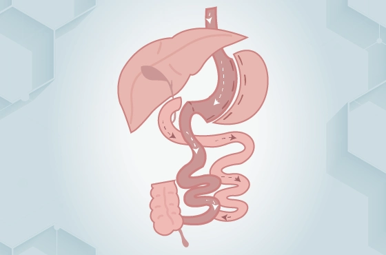 Duodenal Switch