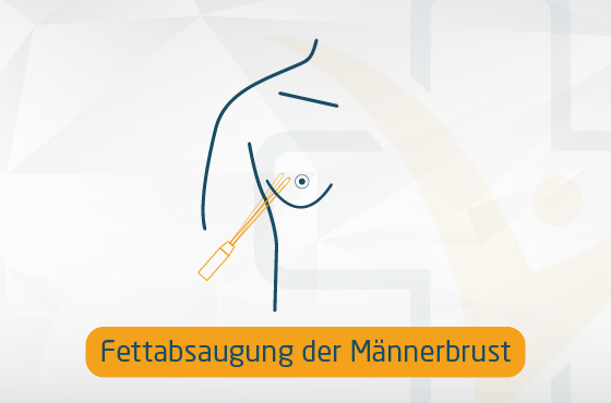 Fettabsaugung der Männerbrust