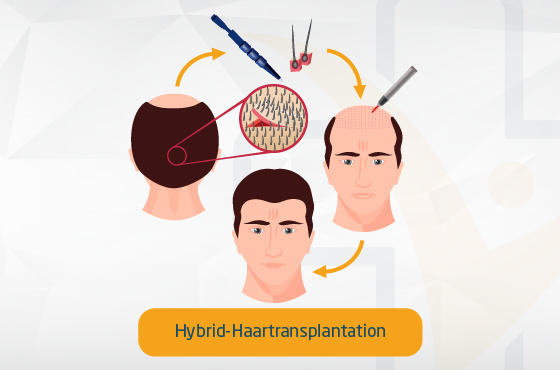 Hybrid-Haartransplantation Türkei: Kosten ab 2.190 €