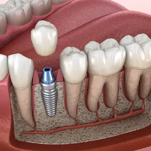Zirkonekrone mit Implantat Türkei