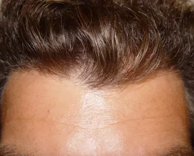 Natürliche Haarlinie bei Haartransplantation mit den richtigen Methoden