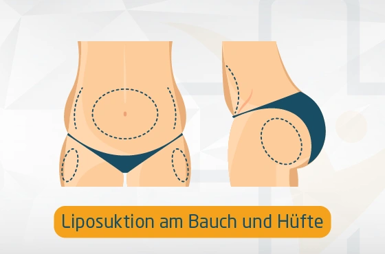 Liposuktion am Bauch und Hüfte