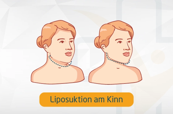 Liposuktion am Kinn Fettabsaugung Türkei / Antalya – Arme