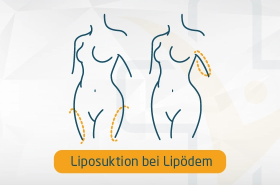 Fettabsaugung in Antalya Liposuktion bei Lipödem