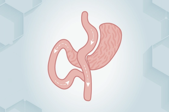 Mini-Magenbypass