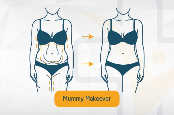 Mommy Makeover Türkei / Antalya: Kosten in Raten zahlen ✓