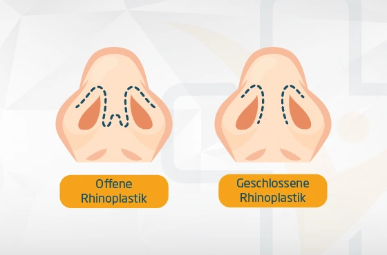 Offene-Geschlossene Rhinoplastik Türkei