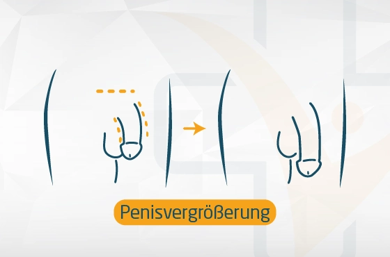 Penisvergrößerung in der Turkei Der Prozess