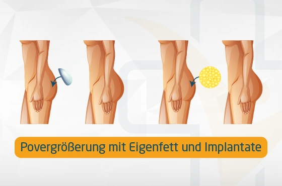 Povergrößerung mit Eigenfett und Implantate