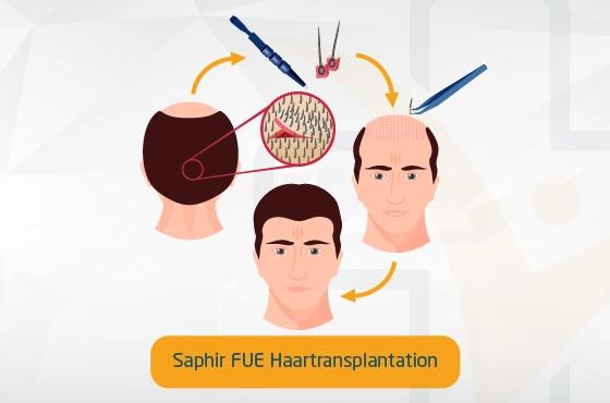 Saphir FUE Haartransplantation Turkei Ablauf