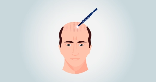 Saphir FUE Haartransplantation