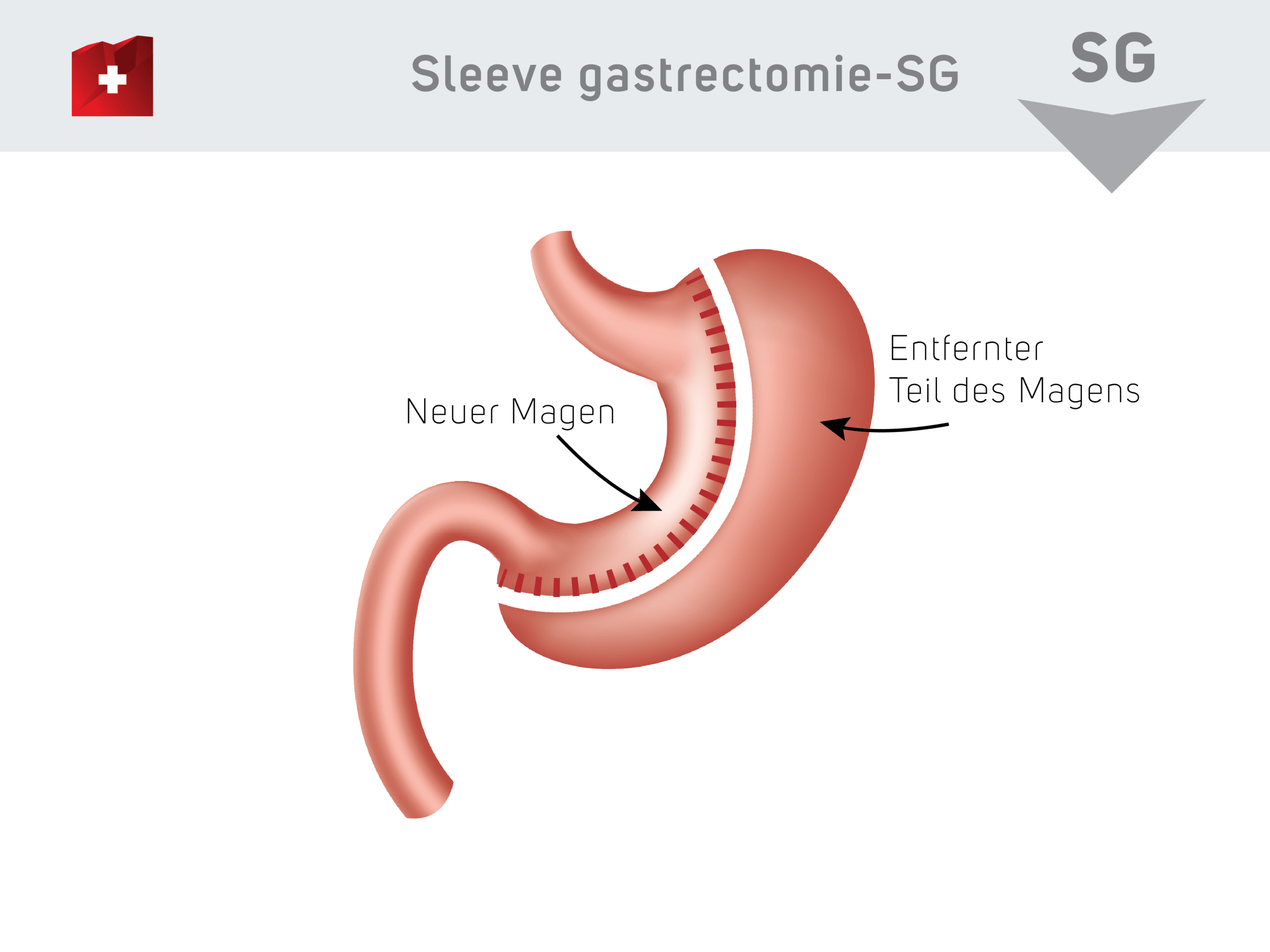 Sleeve Gastrektomie Türkei Ein Weg zu einem gesünderen Leben