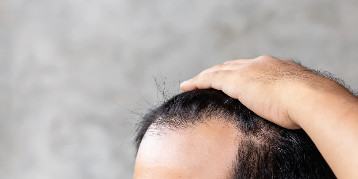 Stoppt der Haarausfall nach einer Eigenhaartransplantation Haartransplantation Haaverpflanzung