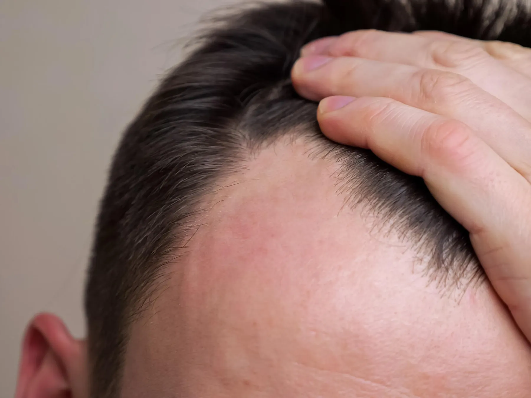 Stoppt der Haarausfall nach einer Haartransplantation?