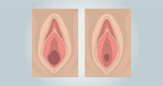 Vaginalstraffung Vaginalverjüngung in der Türkei