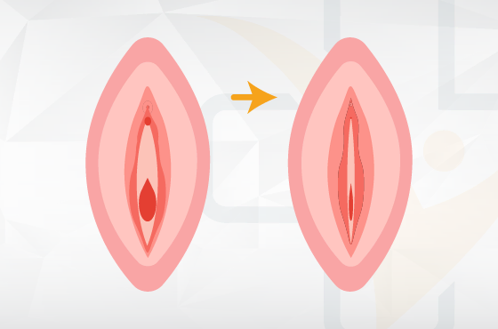 Vaginalstraffung durch Einspritzung von Eigenfett