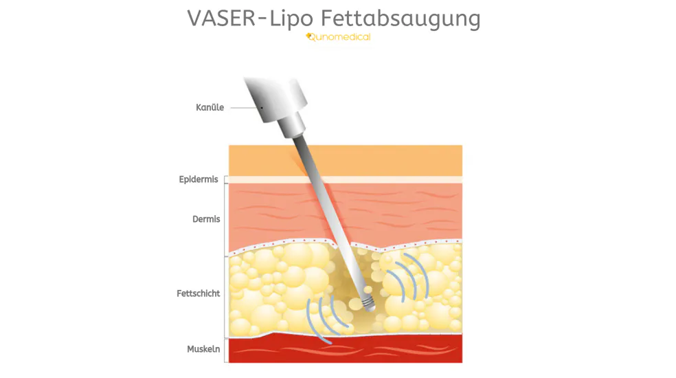Was ist eine Vaser-Liposuktion? 2024 Ausfühliche Erklärung