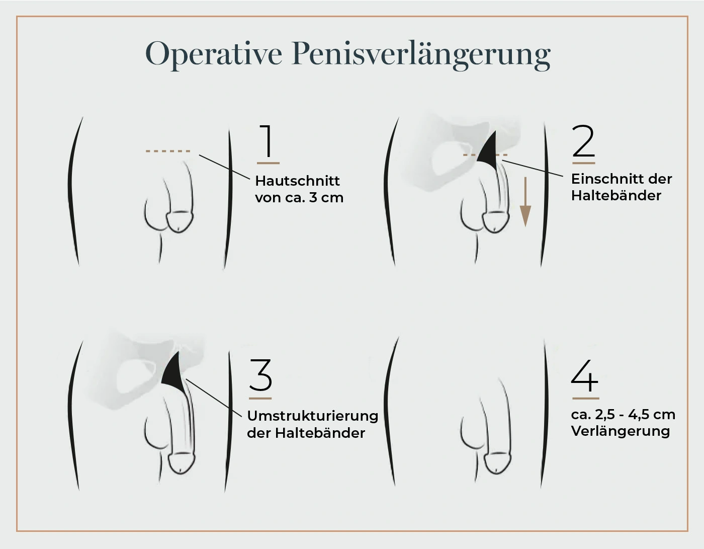 Vergrößern Sie Ihren Penis: Penoplasty in der Türkei 2.990€
