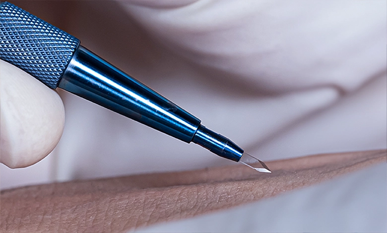 Was ist die Saphir-FUE Haartransplantation? Die 4 Phasen