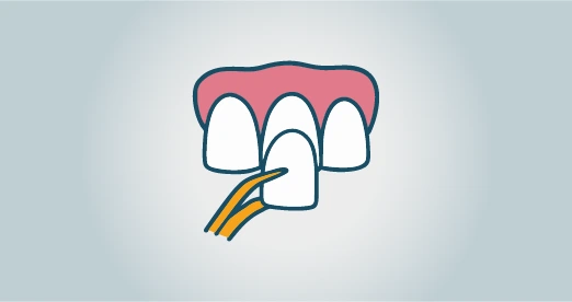 Zahn Veneers Türkei Kosten