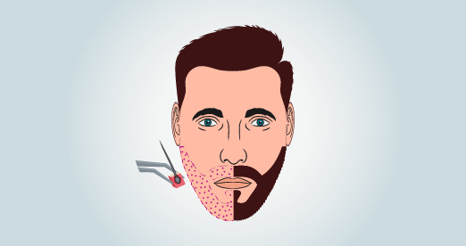 Barttransplantation Türkei Kosten