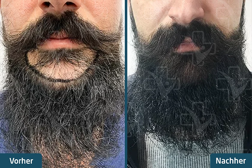 barttransplantation turkei vorher nachher 1
