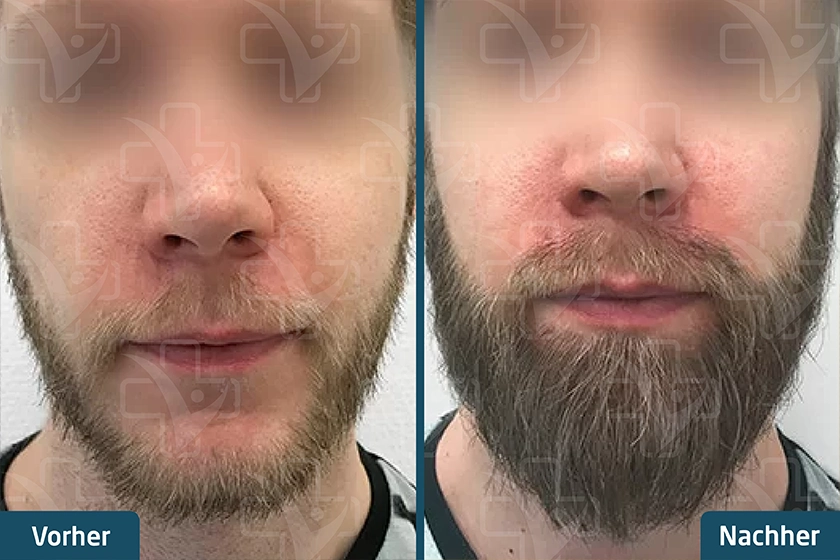 Barttransplantation Türkei Vorher Nachher