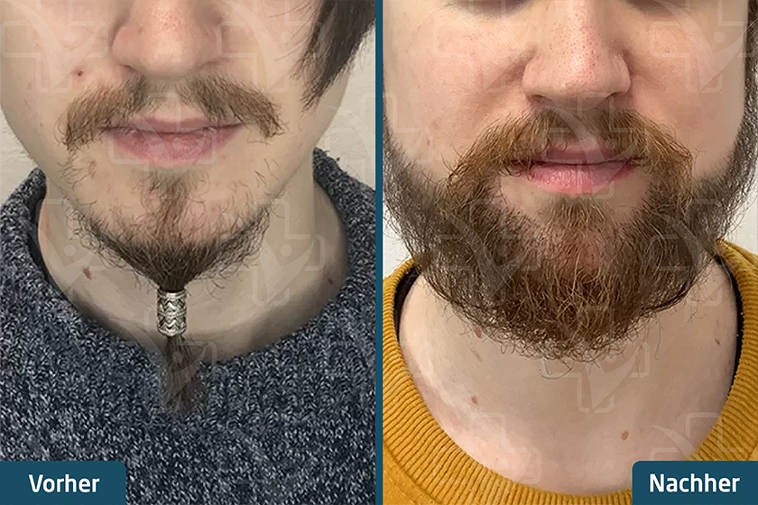 Barttransplantation Türkei Vorher Nachher