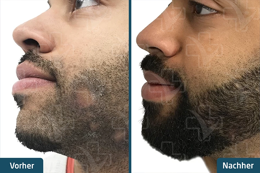 Barttransplantation Türkei Vorher Nachher
