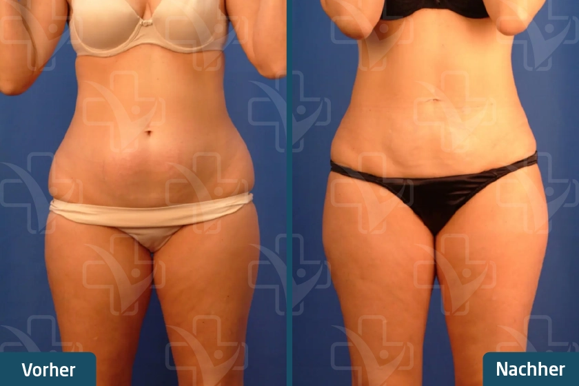 before after 3