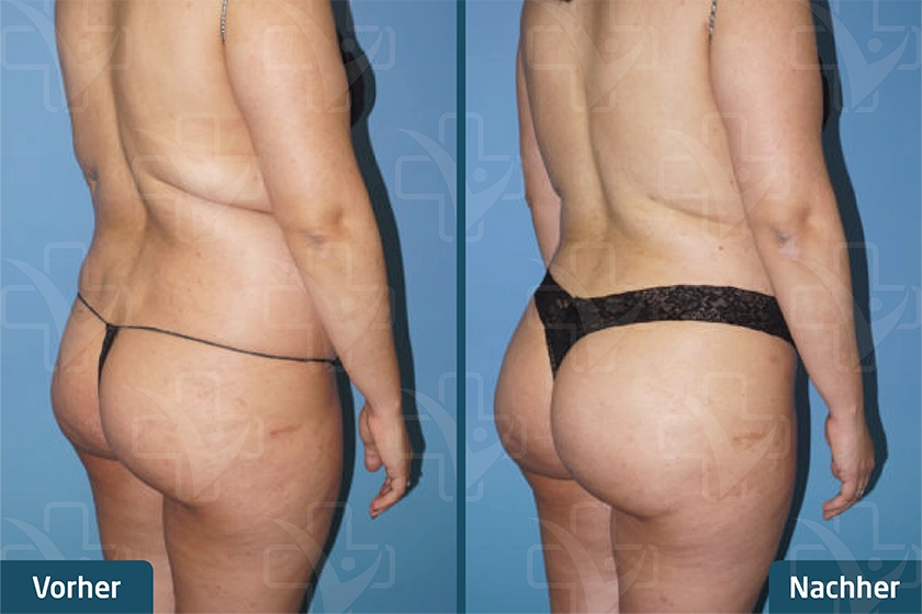 Brazilian Butt Lift (BBL) Türkei Vorher-Nachher von Med Center Türkiye Leitfaden für BBL in der Türkei bei Med Center Türkiye