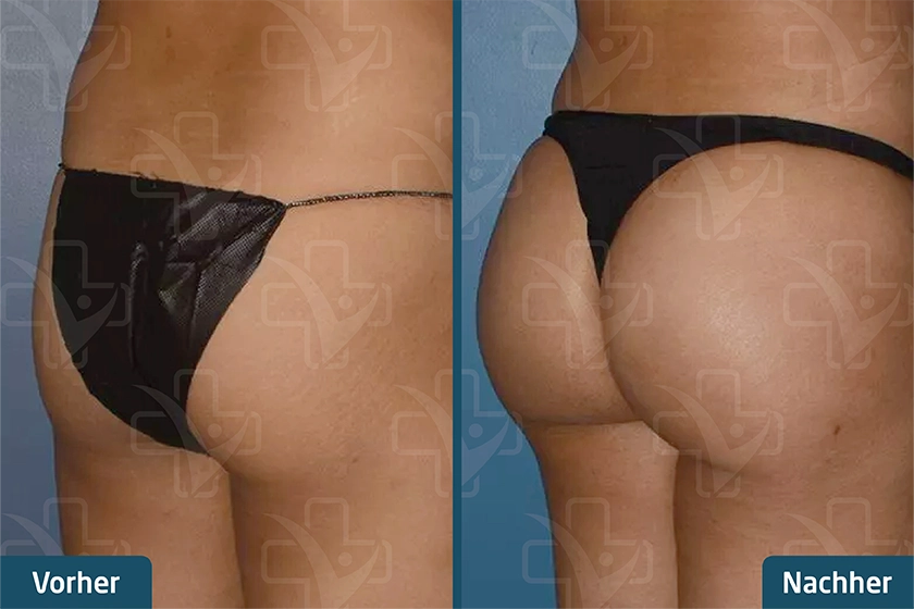 Brazilian Butt Lift (BBL) Türkei Vorher Nachher