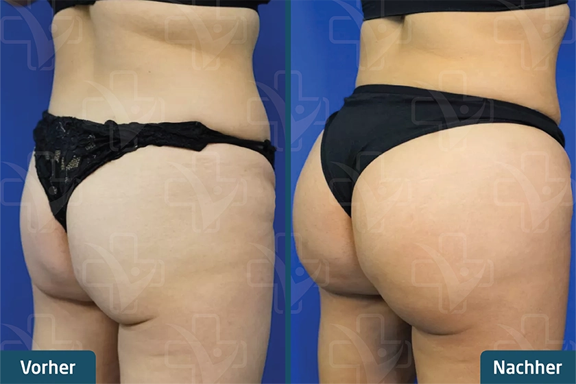 Brazilian Butt Lift (BBL) Türkei Vorher Nachher