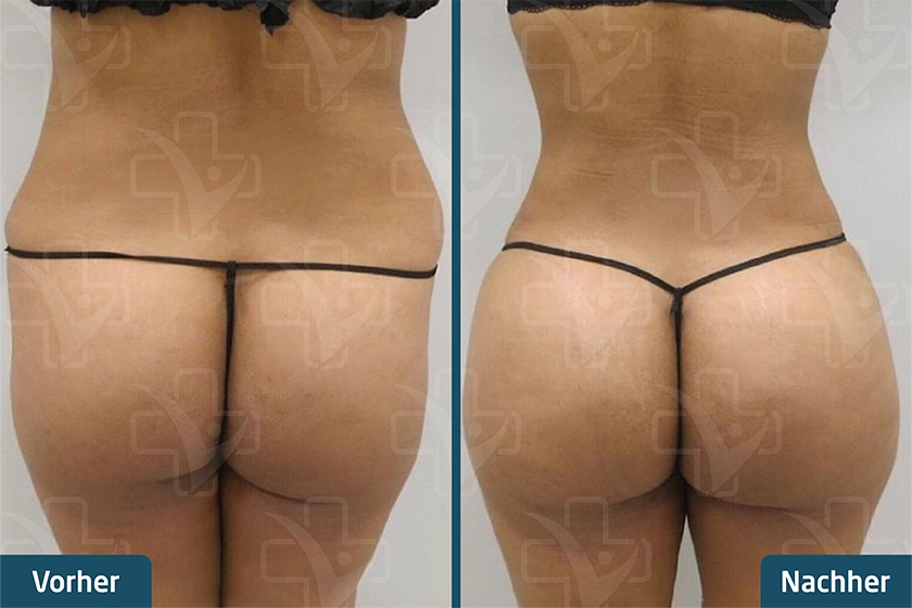 Brazilian Butt Lift (BBL) Türkei Vorher Nachher