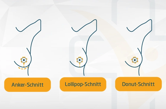 Brustverkleinerung – Schnittführung