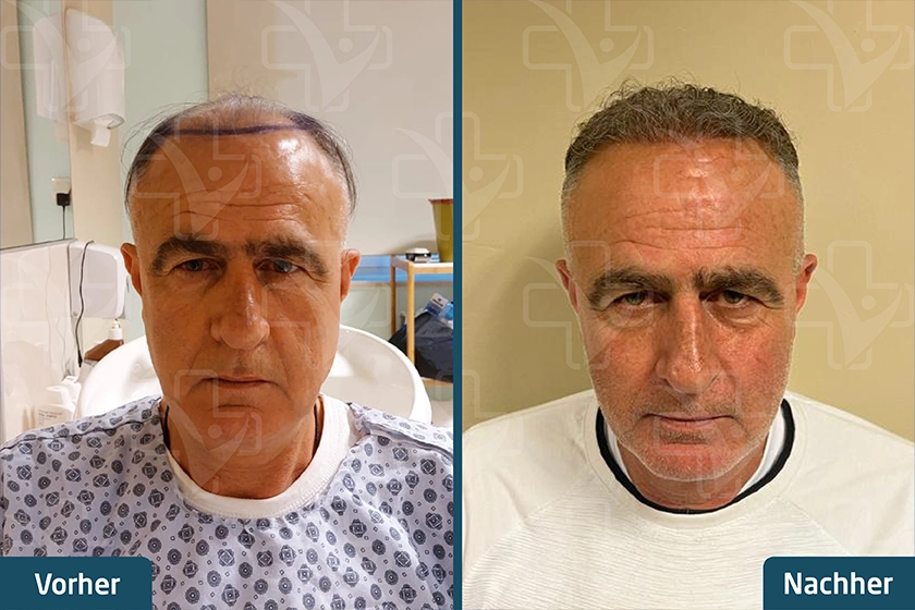 DHI Haartransplantation Türkei Vorher Nachher