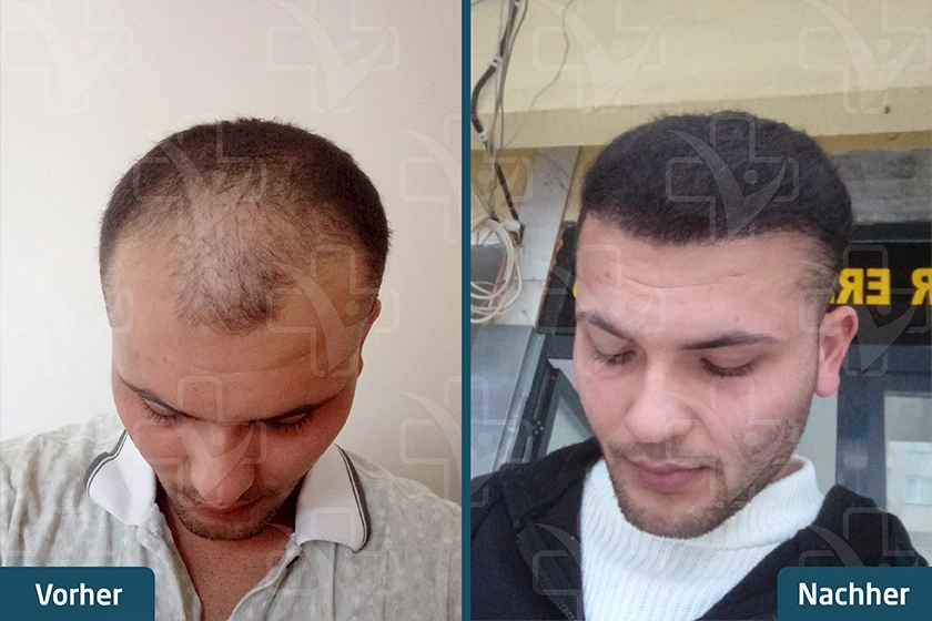 DHI Haartransplantation Türkei Vorher Nachher