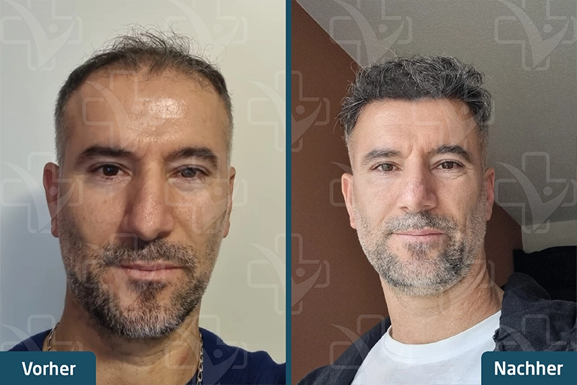 DHI Haartransplantation Türkei Vorher Nachher