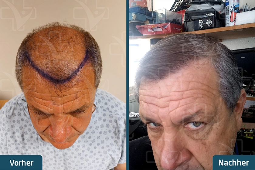 dhi haartransplantation turkei vorher nachher 4