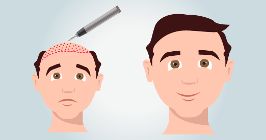 Beste Klinik Med Center Türkiye DHI-Haartransplantation Türkei Kosten
