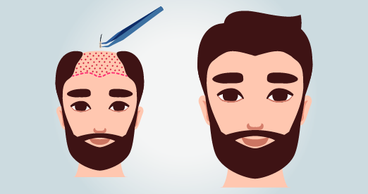 FUE-Haartransplantation Türkei: Kosten ab 1,490 Ratenzahlung
