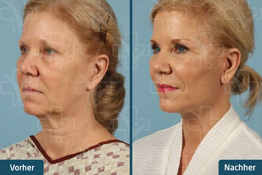 Gesichtsstraffung Face Lift Türkei Vorher Nachher