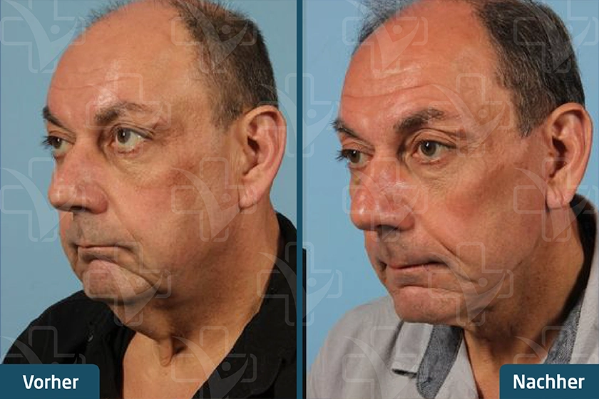 Gesichtsstraffung Face Lift Türkei Vorher Nachher