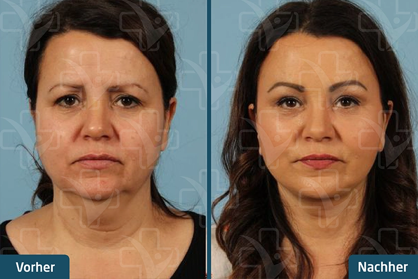 Gesichtsstraffung Face Lift Türkei Vorher Nachher